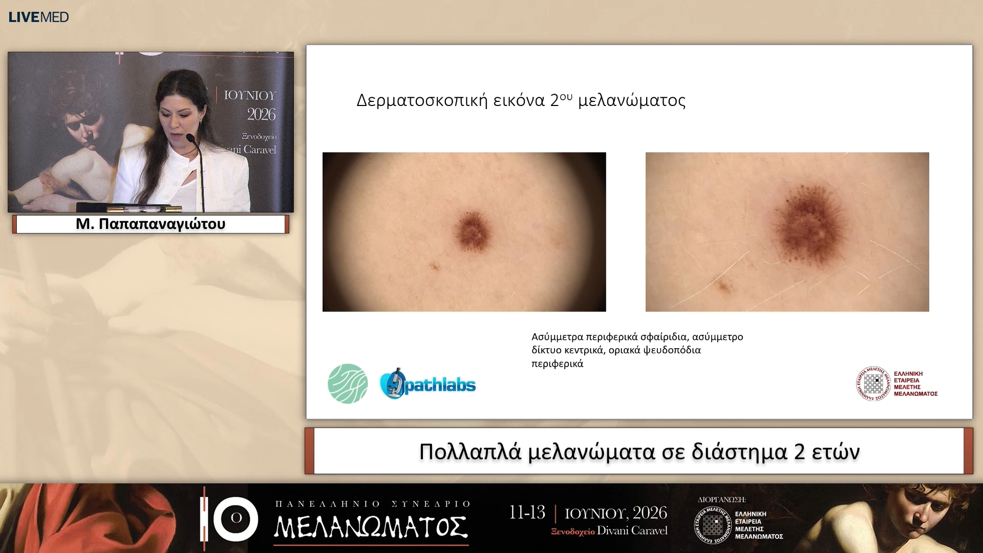 25 ΕΑ02 Πολλαπλά μελανώματα σε διάστημα 2 ετών