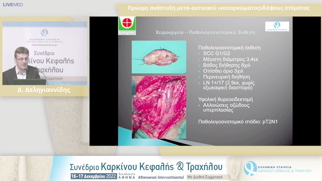 38 Δ. Δεληγιαννίδης - Πρώιμη ανάπτυξη μετα-ακτινικού ινοσαρκώματοςεδάφους στόματος.
