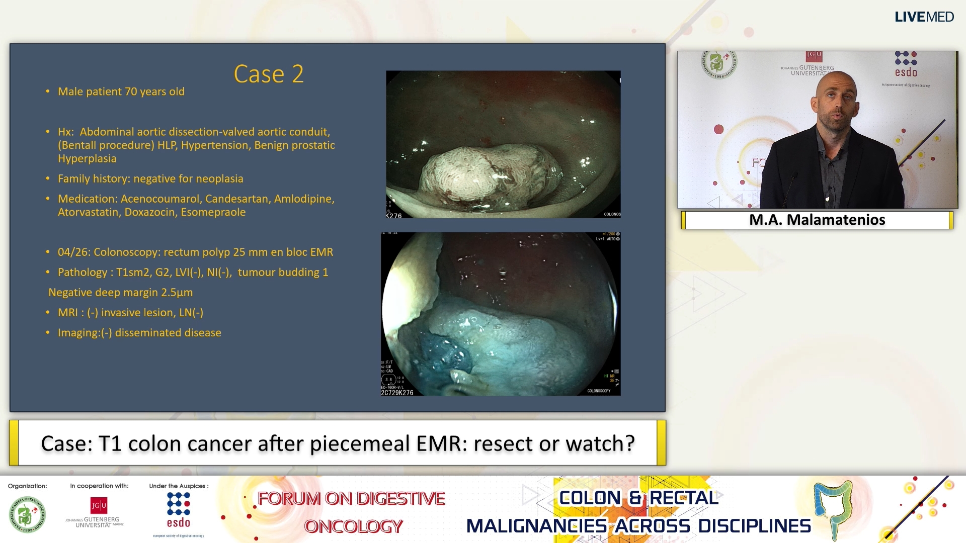 07 M.A. Malamatenios - Case: T1 colon cancer after piecemeal EMR: resect or watch?