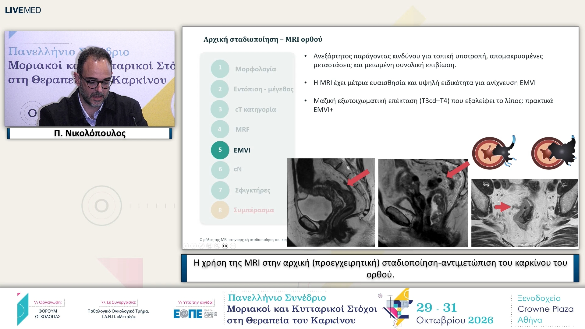 33 Π. Νικολόπουλος - Η χρήση της MRI στην αρχική (προεγχειρητική) σταδιοποίηση-αντιμετώπιση του καρκίνου του ορθού.