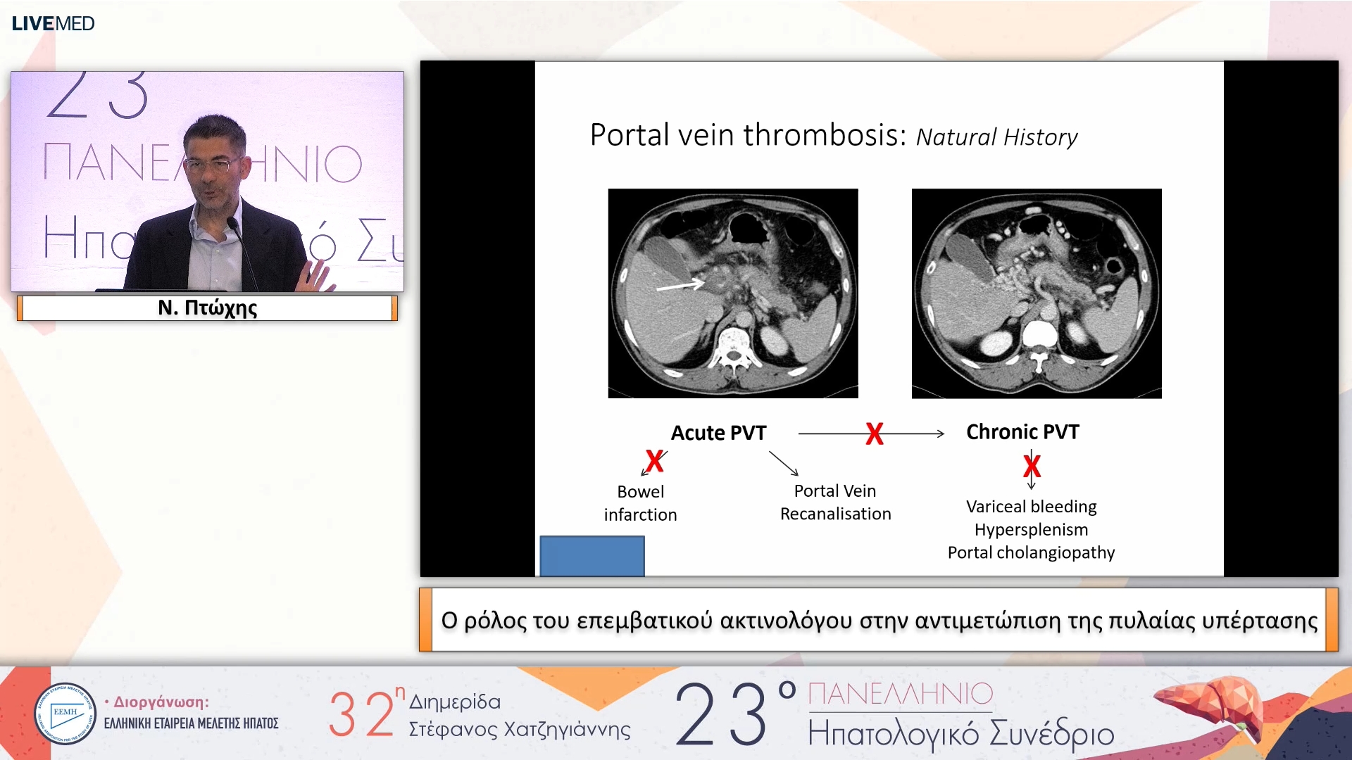 093 Ν. Πτώχης - Ο ρόλος του επεμβατικού ακτινολόγου στην αντιμετώπιση της πυλαίας υπέρτασης