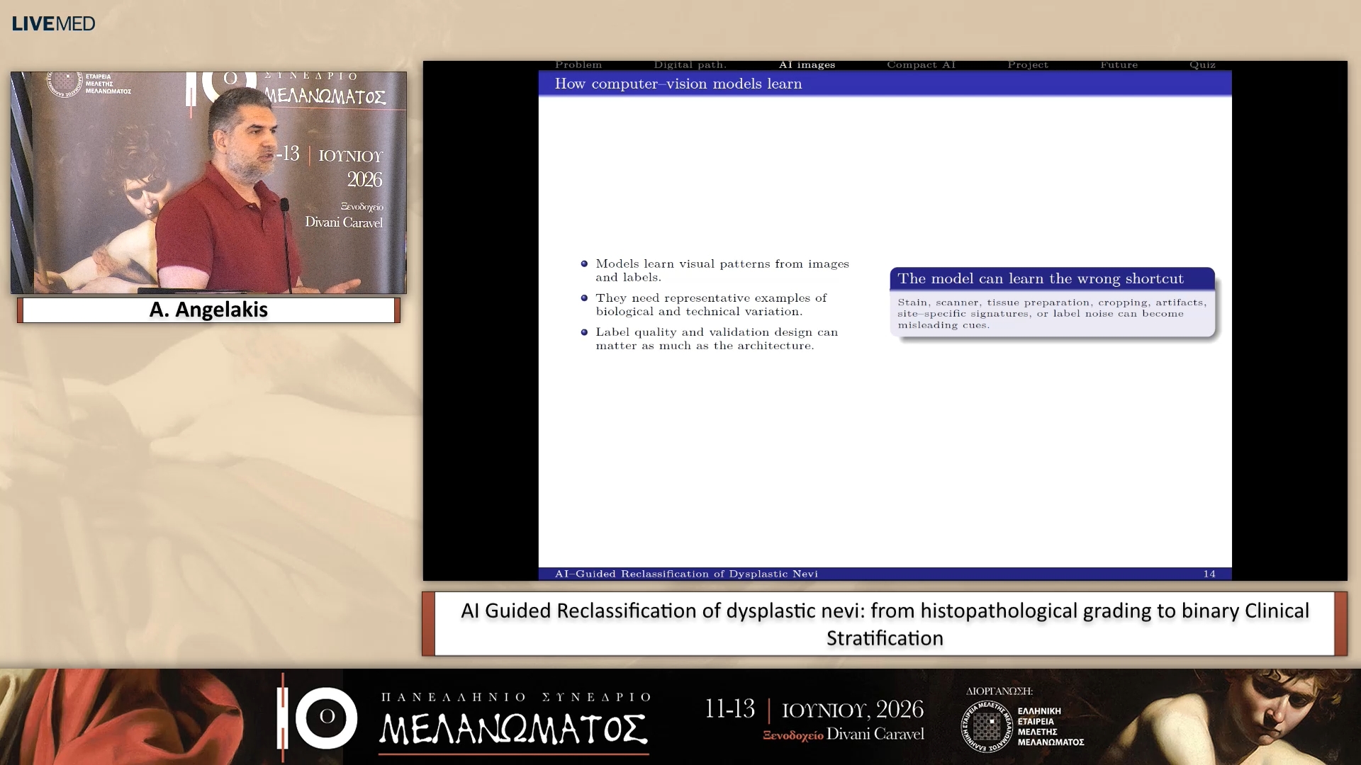 32 A. Angelakis - ΑΙ Guided Reclassification of dysplastic nevi: from histopathological grading to binary Clinical Stratification