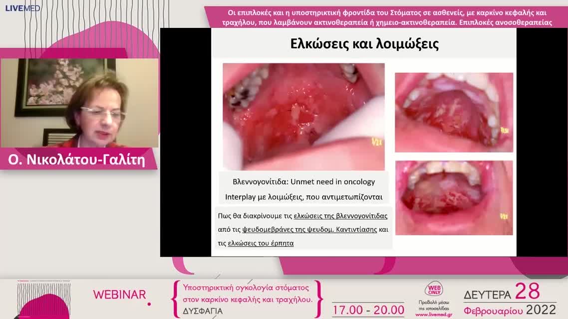 01 Ο. Νικολάτου-Γαλίτη - Οι επιπλοκές και η υποστηρικτική φροντίδα του Στόματος σε ασθενείς, με καρκίνο κεφαλής και τραχήλου, που λαμβάνουν ακτινοθεραπεία ή χημειο-ακτινοθεραπεία. Επιπλοκές ανοσοθεραπείας. 